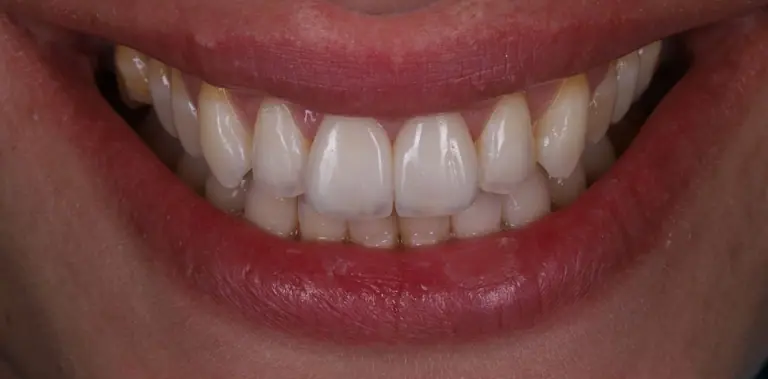 Caso 06: sorriso final com facetas sobre modelo refratário