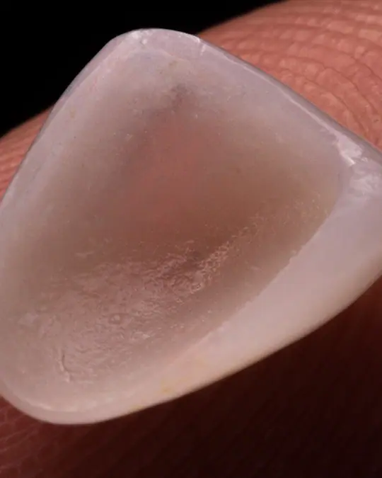 Pormenor de uma faceta em cerâmica feldspática CAD/CAM sobre a ponta de um dedo