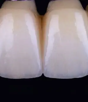 Pormenor de uma ponte em zircónia estratificada com cerâmica, nos incisivos centrais